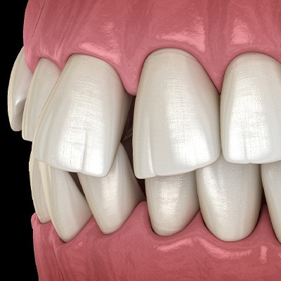 Illustration of gapped teeth