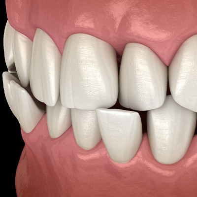 Illustration of a crossbite