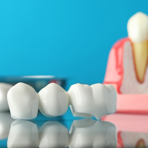 A dental bridge near an educational gum model with a dental implant