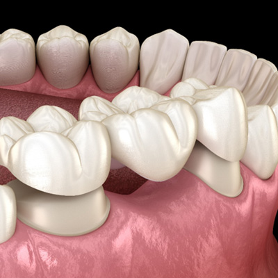 A 3D illustration of a dental bridge