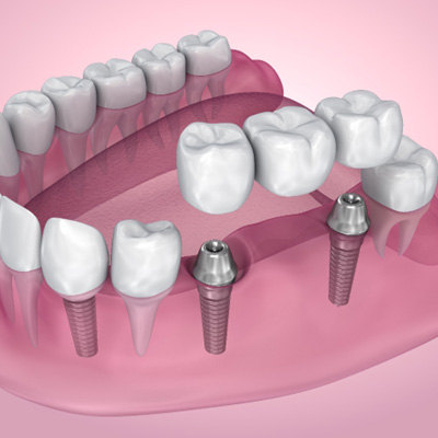  A 3D illustration of an implant bridge