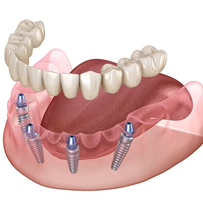 Illustration of implant dentures being attached