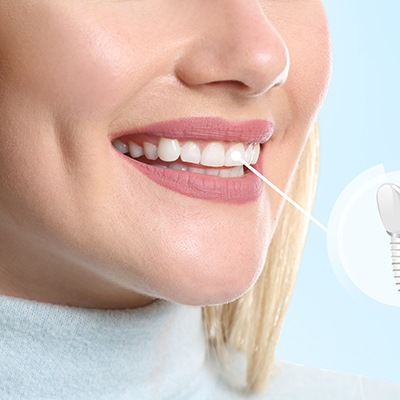 Blond woman smiling with one tooth indicated as an implant